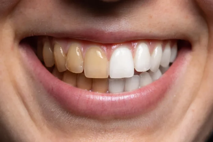 Teeth Whitening in Parker, AZ