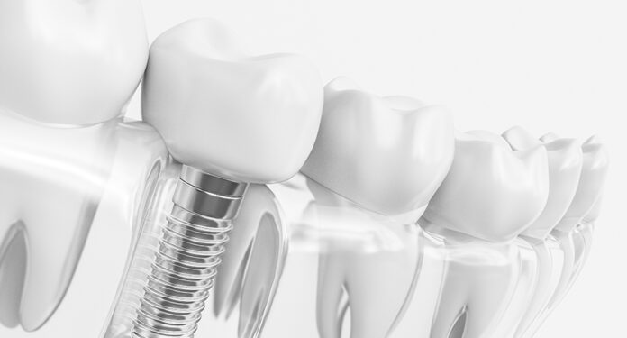 Dental Implant