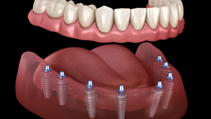 FIXED IMPLANT DENTURES