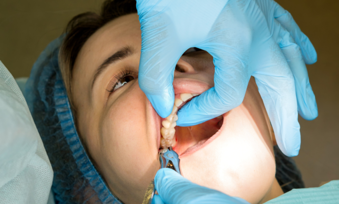 Tooth Extractions in Tempe