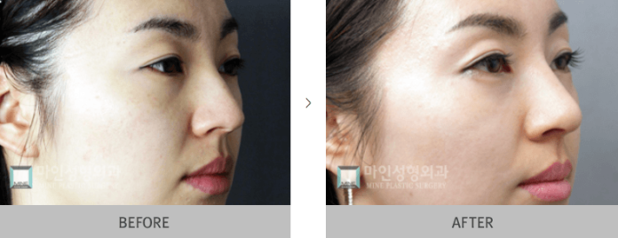 best Rhinoplasty surgeon in Korea