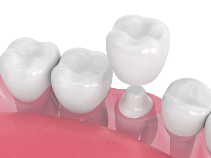 Dental Crowns in Lake Havasu City