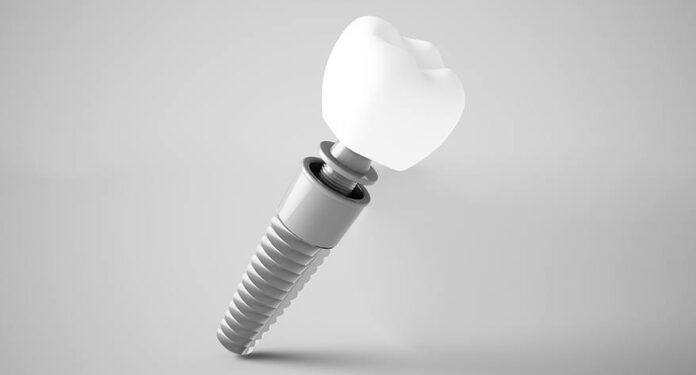 Replacing Missing Teeth