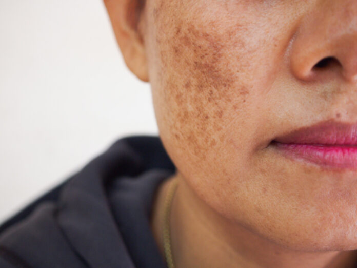 brown spots on skin removal