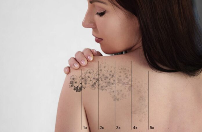 Laser Tattoo Removal in Dubai