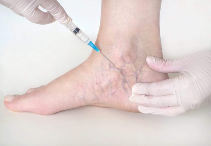 Spider Veins Treatment in Dubai