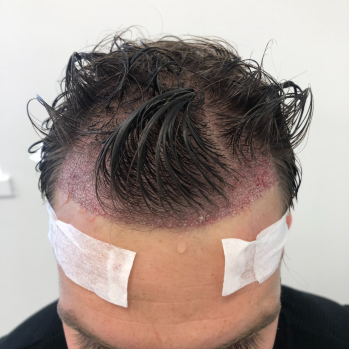 Hair Transplant in Dubai