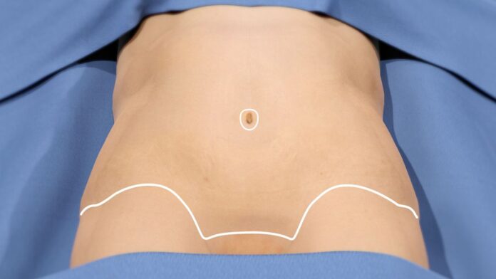 Tummy Tuck in Dubai