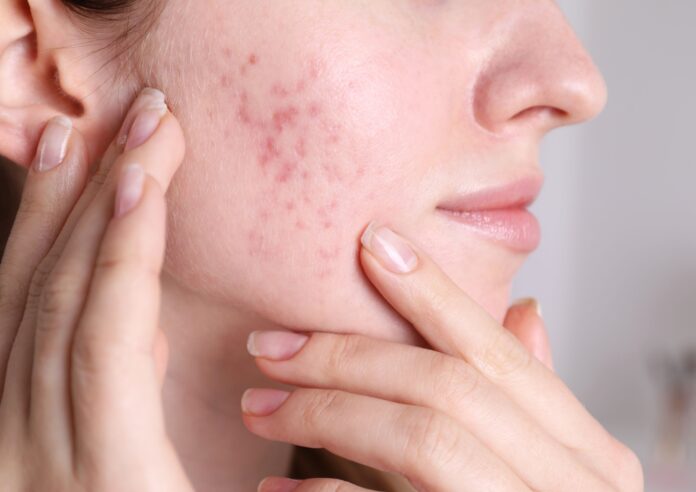 Acne Scar Treatment in Dubai
