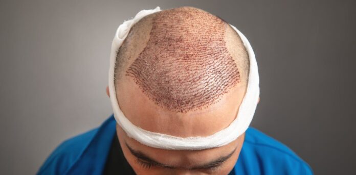 Hair Transplant in Dubai