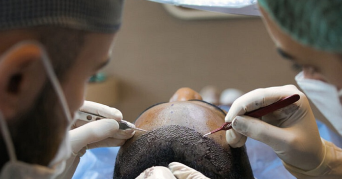 hair transplant