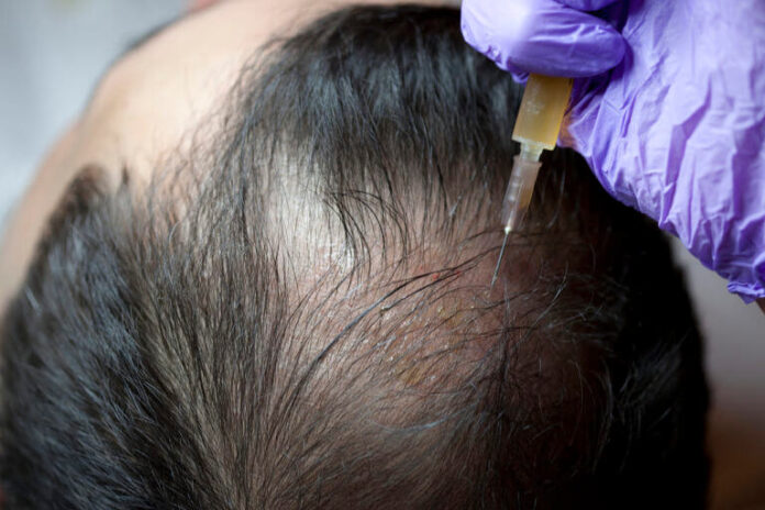 PRP Hair Treatment in Dubai