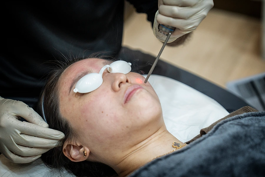 Pico Laser Treatment in Dubai