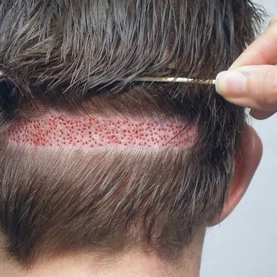 HAIR TRANSPLANT IN DUBAI