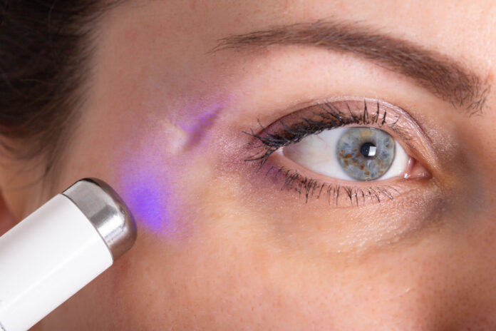 Scar Laser Treatment In Dubai