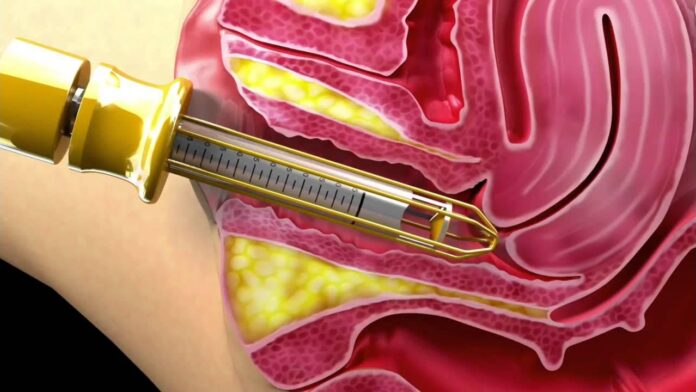 Vaginal Rejuvenation in Dubai