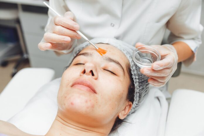 Are Peels Good for Dark Spots on Face?