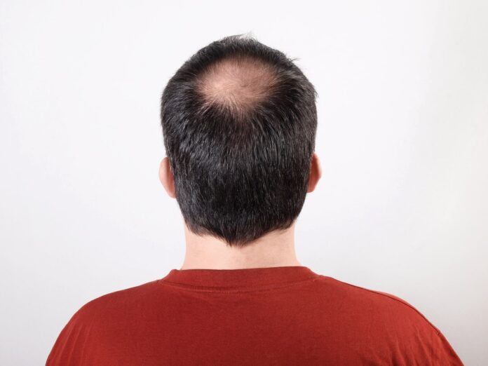 Does Hair Transplant Work on Crown Baldness?