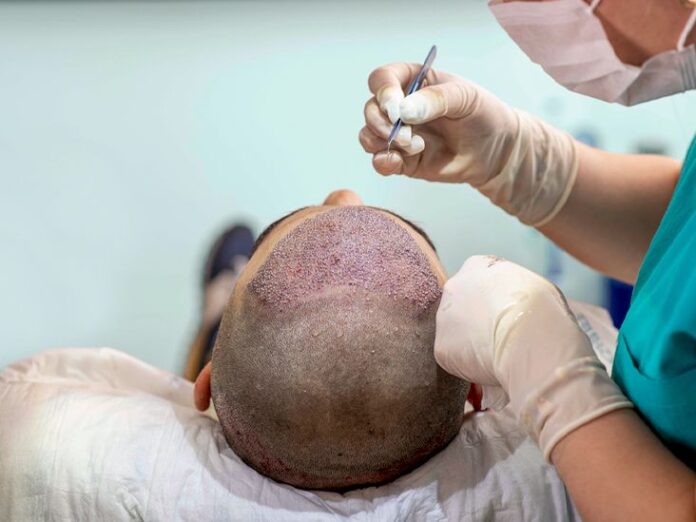 How Does Hair Transplant Surgery Work?