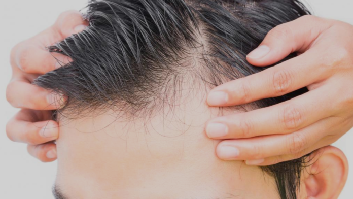 Is Hair Transplant Suitable for All Ages?