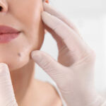 Is It Safe to Remove Moles on the Face?