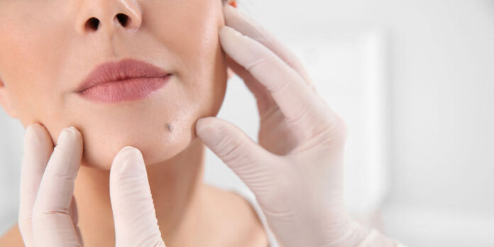 Is It Safe to Remove Moles on the Face?
