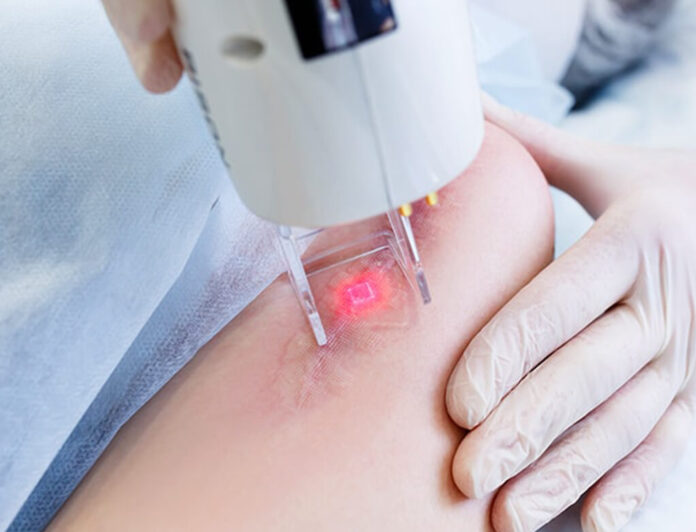 Laser Scar Removal
