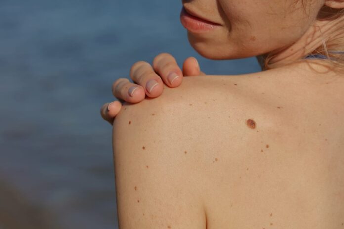 When Should a Mole Be Removed?