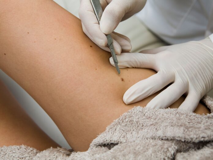 Cellfina Treatment in Dubai.