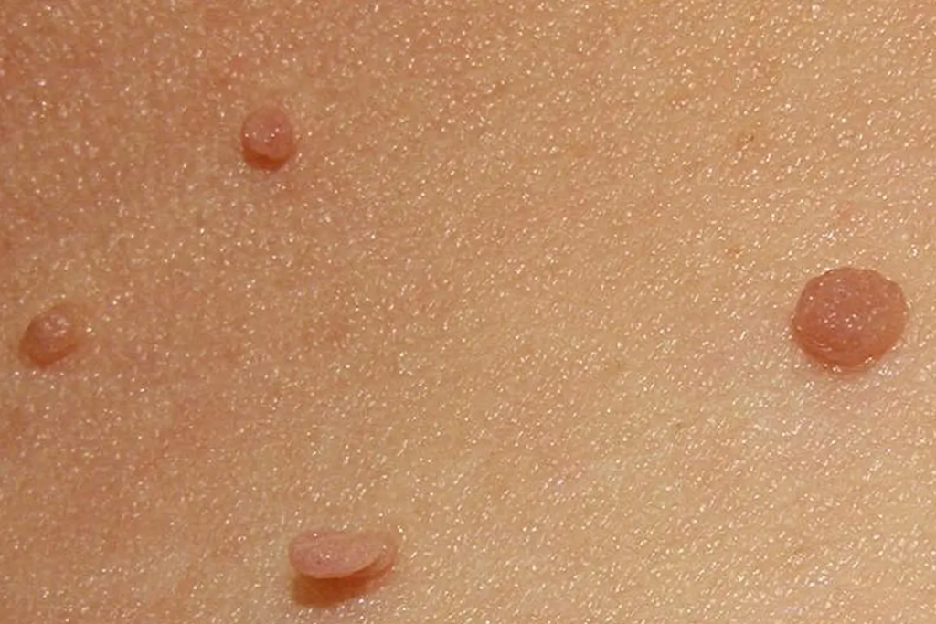 skin tag removal