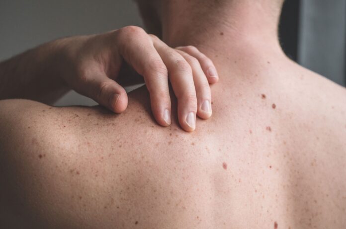 Skin Tag Removal in Dubai.